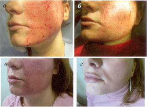 етапи на възстановяване на кожата след процедура на фракционна аблация