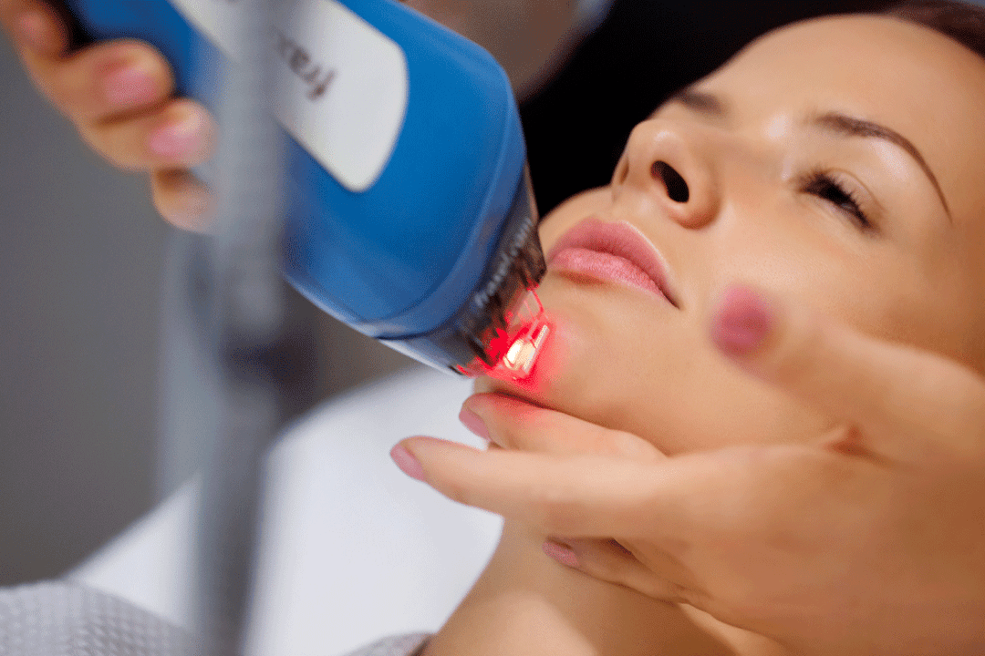 лазерно подмладяване на кожата на лицето