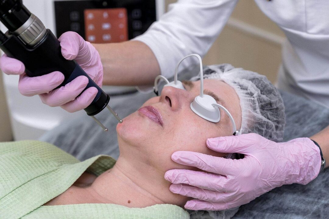 Аблативна лазерна процедура за подмладяване на кожата