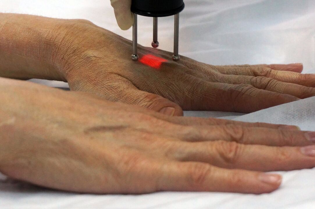Лазерно подмладяване на ръцете с неаблативен метод