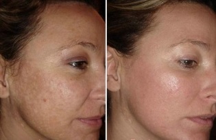 лазерно подмладяване на кожата на лицето преди и след снимки